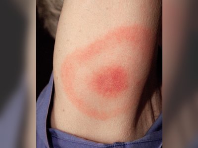 Researchers May Have Found a Perfect Treatment Method for Lyme Disease